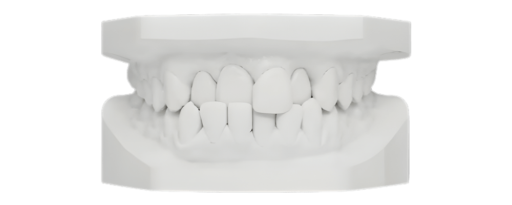 Noxi Cross Bite