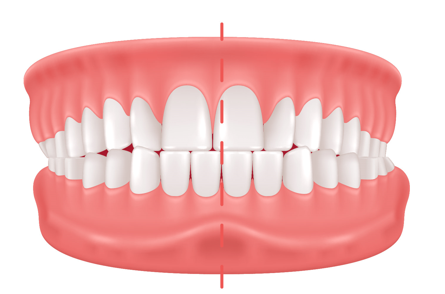 Crossbite