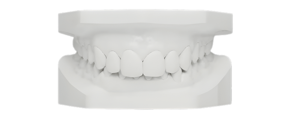 Noxi Deep Bite