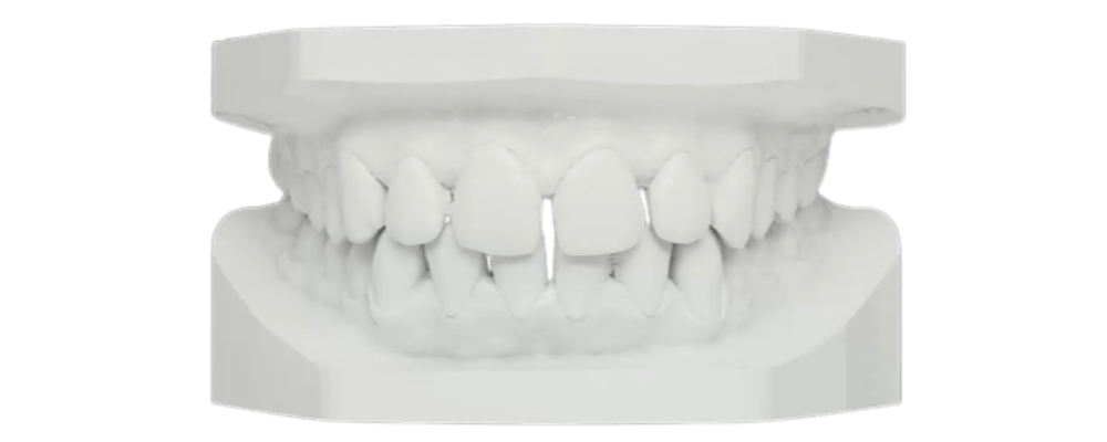 Noxi Diastema