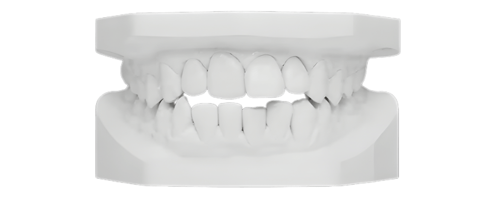 Noxi Open Bite