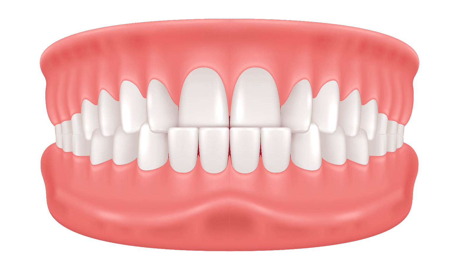 Underbite